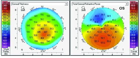 thick cornera measurement a 6|thickness of the cornea.